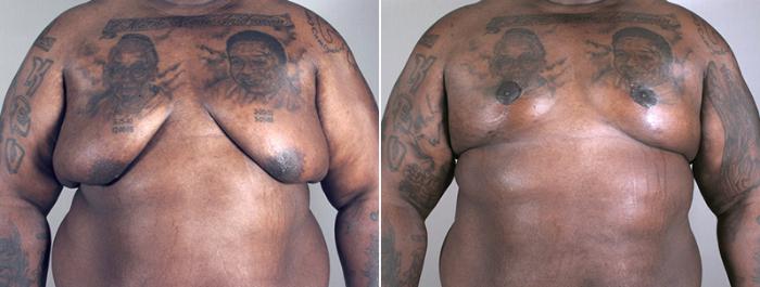 Male Breast Reduction Case 629 Before & After View #1 | Paramus, New Jersey | Parker Center for Plastic Surgery