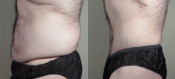 Male Breast Reduction Case 673 Before & After View #3 | Paramus, New Jersey | Parker Center for Plastic Surgery