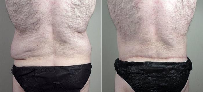 Male Breast Reduction Case 673 Before & After View #4 | Paramus, New Jersey | Parker Center for Plastic Surgery