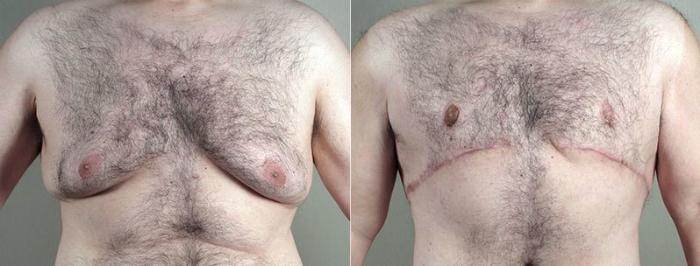 Male Breast Reduction Case 673 Before & After View #5 | Paramus, New Jersey | Parker Center for Plastic Surgery