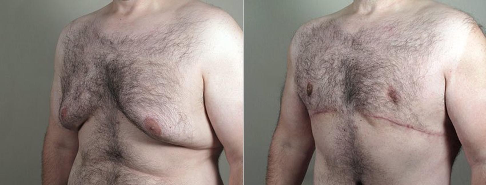 Male Breast Reduction Case 673 Before & After View #6 | Paramus, New Jersey | Parker Center for Plastic Surgery