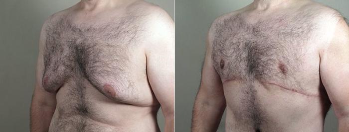 Male Breast Reduction Case 673 Before & After View #6 | Paramus, New Jersey | Parker Center for Plastic Surgery