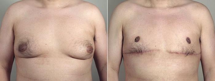 Male Breast Reduction Case 675 Before & After View #1 | Paramus, New Jersey | Parker Center for Plastic Surgery