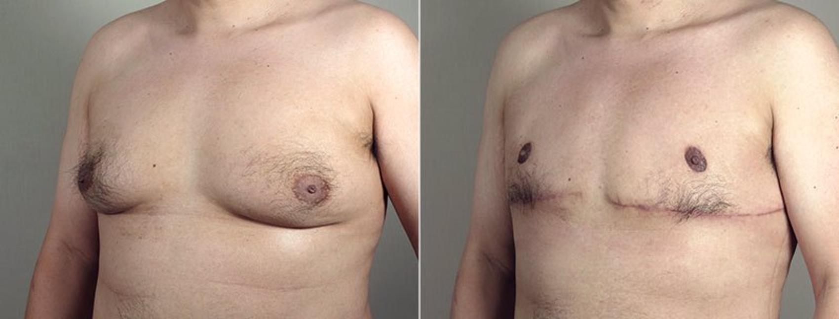 Male Breast Reduction Case 675 Before & After View #2 | Paramus, New Jersey | Parker Center for Plastic Surgery