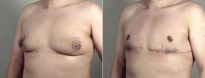 Male Breast Reduction Case 675 Before & After View #2 | Paramus, New Jersey | Parker Center for Plastic Surgery
