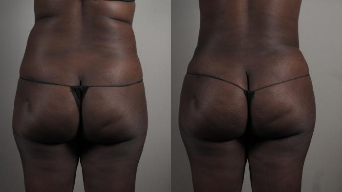 Mommy Makeover Case 1005 Before & After Back | Paramus, New Jersey | Parker Center for Plastic Surgery