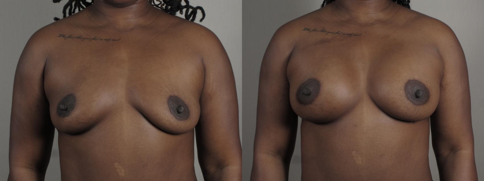Mommy Makeover Case 1005 Before & After Front breast | Paramus, New Jersey | Parker Center for Plastic Surgery