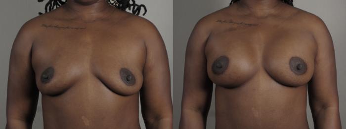 Mommy Makeover Case 1005 Before & After Front breast | Paramus, New Jersey | Parker Center for Plastic Surgery