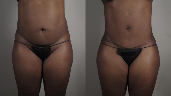 Mommy Makeover Case 1005 Before & After Front | Paramus, New Jersey | Parker Center for Plastic Surgery