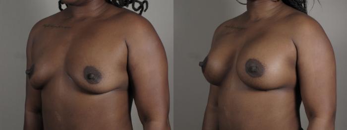 Mommy Makeover Case 1005 Before & After Right Oblique | Paramus, New Jersey | Parker Center for Plastic Surgery