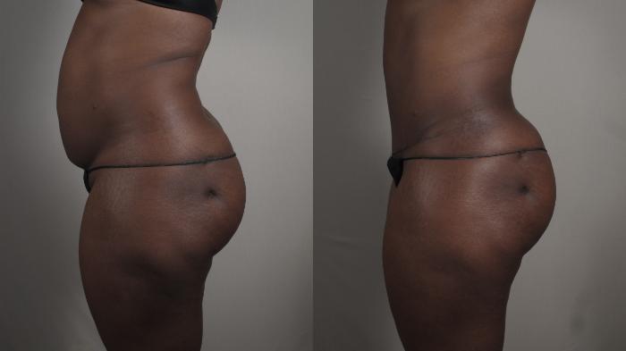 Mommy Makeover Case 1005 Before & After Right Side | Paramus, New Jersey | Parker Center for Plastic Surgery
