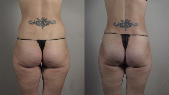 Mommy Makeover Case 1031 Before & After Back | Paramus, New Jersey | Parker Center for Plastic Surgery
