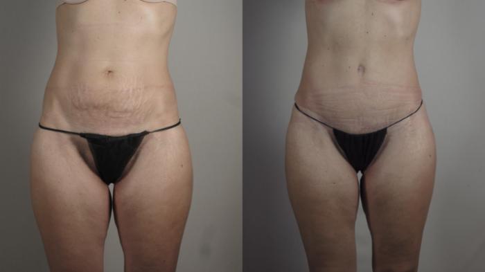 Mommy Makeover Case 1031 Before & After Front Body  | Paramus, New Jersey | Parker Center for Plastic Surgery