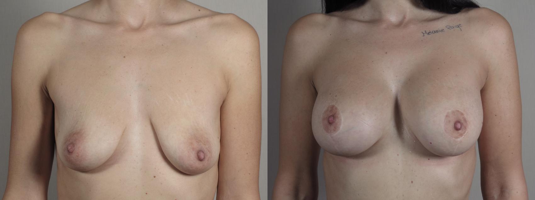 Mommy Makeover Case 1031 Before & After Front | Paramus, New Jersey | Parker Center for Plastic Surgery