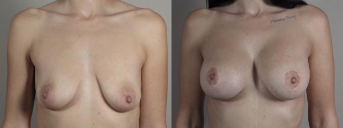 Mommy Makeover Case 1031 Before & After Front | Paramus, New Jersey | Parker Center for Plastic Surgery