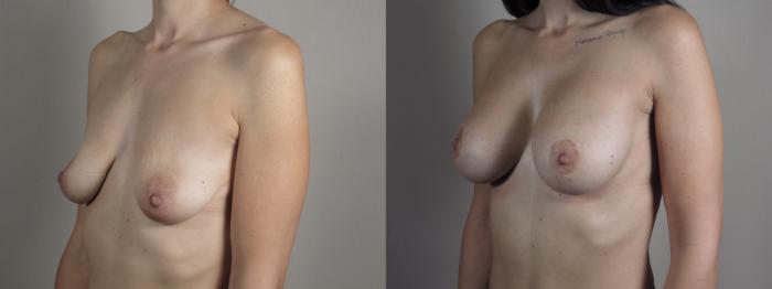 Mommy Makeover Case 1031 Before & After Right Oblique | Paramus, New Jersey | Parker Center for Plastic Surgery