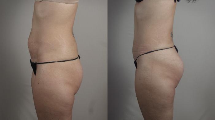 Mommy Makeover Case 1031 Before & After Right Side | Paramus, New Jersey | Parker Center for Plastic Surgery