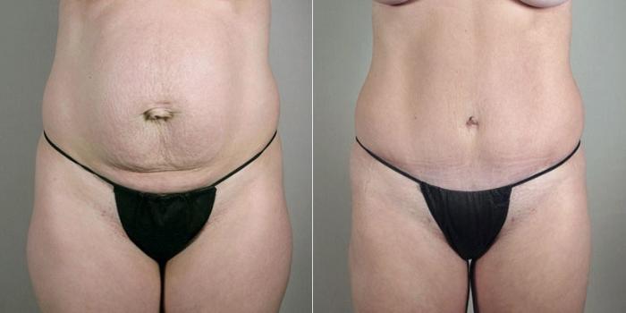Mommy Makeover Case 1183 Before & After View  | Paramus, New Jersey | Parker Center for Plastic Surgery