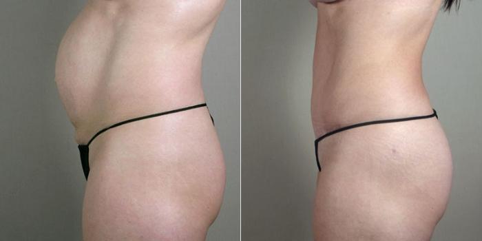 Mommy Makeover Case 1183 Before & After View 2 | Paramus, New Jersey | Parker Center for Plastic Surgery