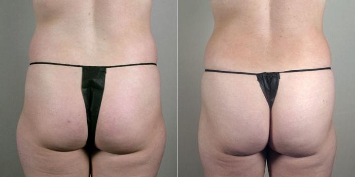 Mommy Makeover Case 1183 Before & After View 3 | Paramus, New Jersey | Parker Center for Plastic Surgery