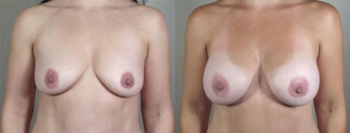 Mommy Makeover Case 1183 Before & After View 4 | Paramus, New Jersey | Parker Center for Plastic Surgery