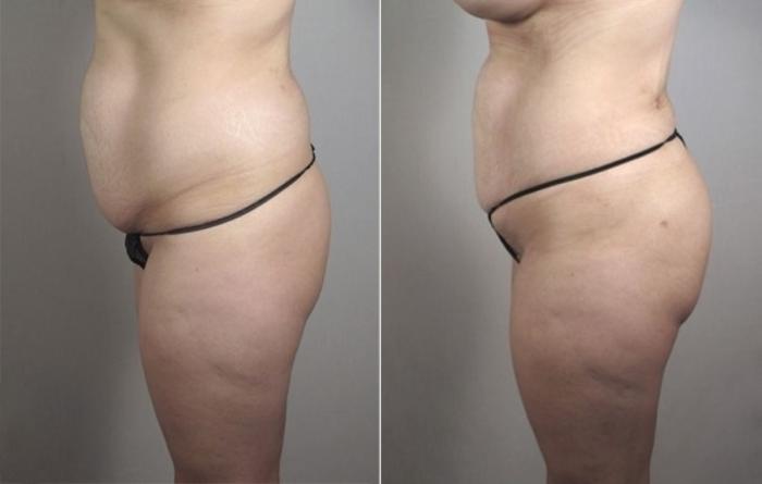 Liposuction Case 1184 Before & After View 1 | Paramus, New Jersey | Parker Center for Plastic Surgery