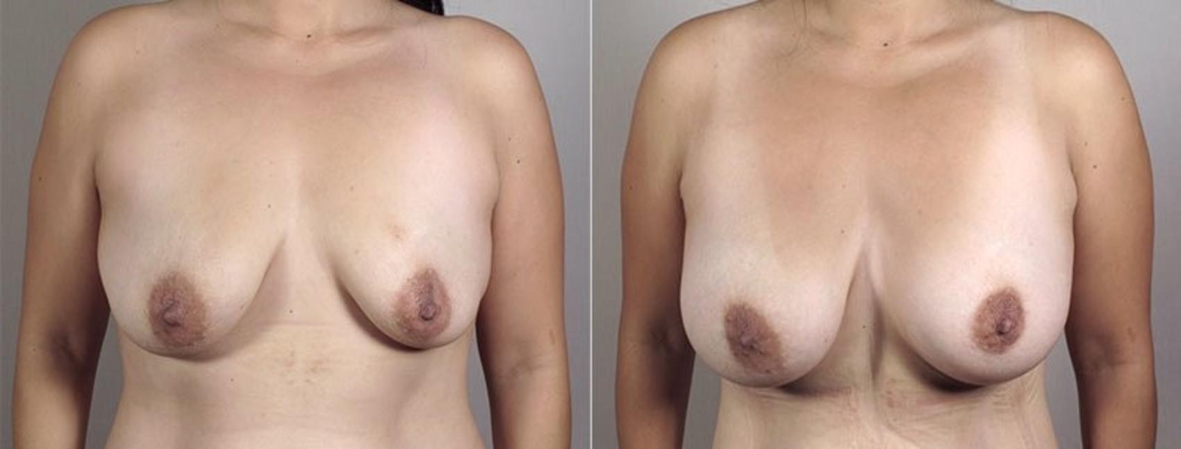 Liposuction Case 1184 Before & After View 2 | Paramus, New Jersey | Parker Center for Plastic Surgery