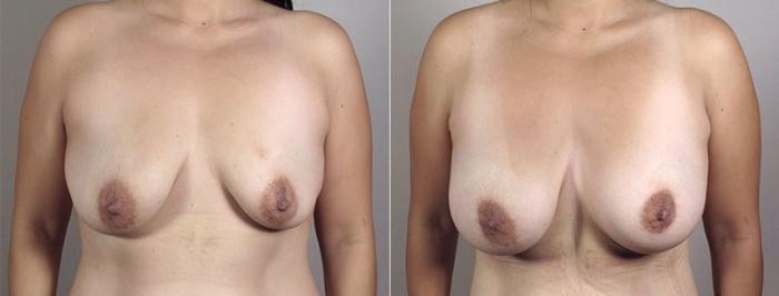 Liposuction Case 1184 Before & After View 2 | Paramus, New Jersey | Parker Center for Plastic Surgery