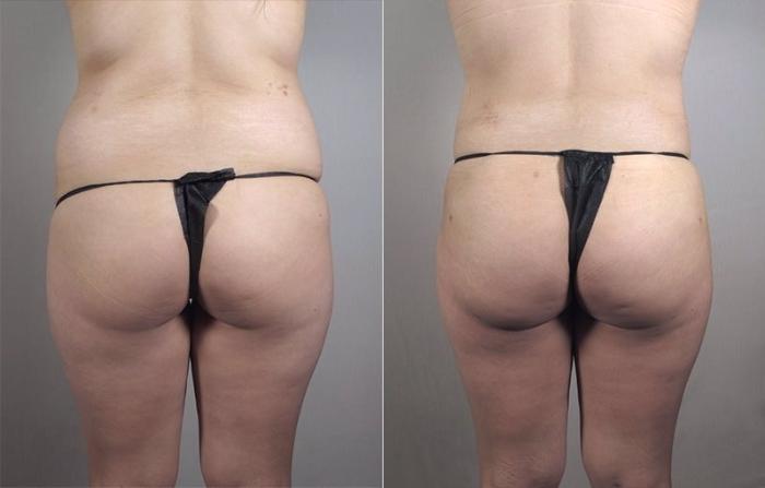 Liposuction Case 1184 Before & After View 3 | Paramus, New Jersey | Parker Center for Plastic Surgery