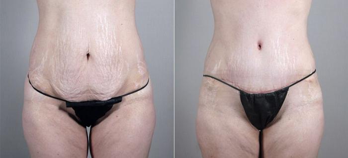Mommy Makeover Case 1185 Before & After View 1 | Paramus, New Jersey | Parker Center for Plastic Surgery