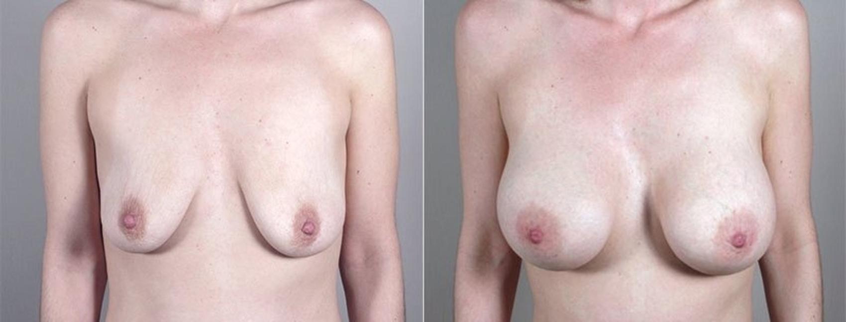 Mommy Makeover Case 1185 Before & After View 3 | Paramus, New Jersey | Parker Center for Plastic Surgery