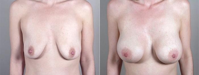 Mommy Makeover Case 1185 Before & After View 3 | Paramus, New Jersey | Parker Center for Plastic Surgery