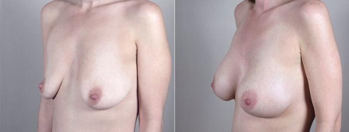 Mommy Makeover Case 1185 Before & After View 4 | Paramus, New Jersey | Parker Center for Plastic Surgery