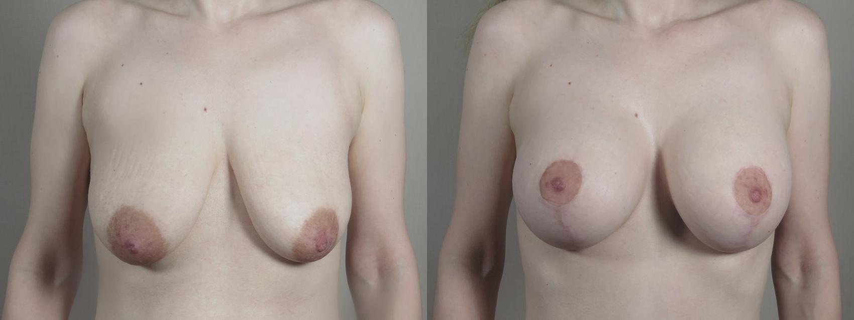 Mommy Makeover Case 1225 Before & After View #1  | Paramus, New Jersey | Parker Center for Plastic Surgery
