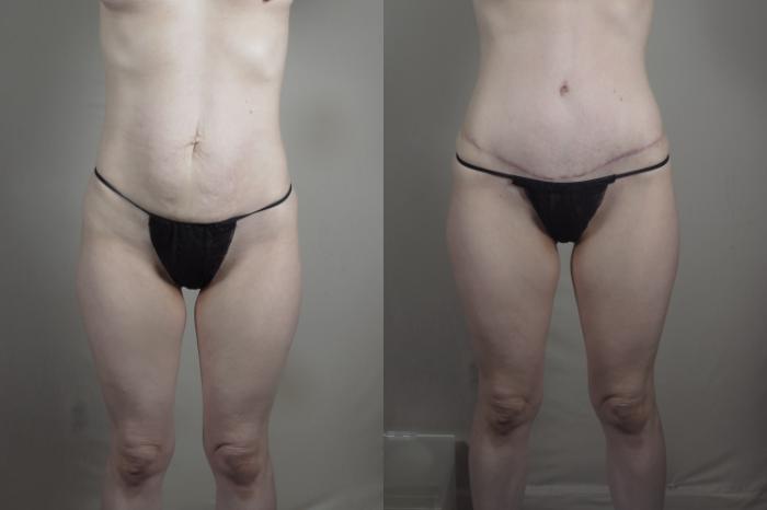 Mommy Makeover Case 1225 Before & After View #2 | Paramus, New Jersey | Parker Center for Plastic Surgery