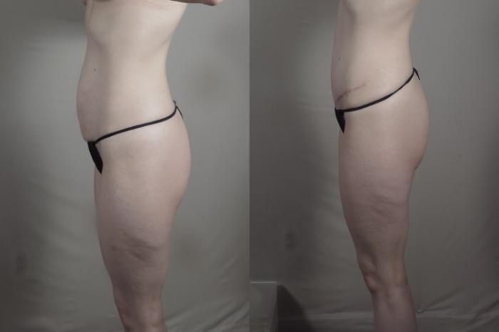 Mommy Makeover Case 1225 Before & After View #3 | Paramus, New Jersey | Parker Center for Plastic Surgery