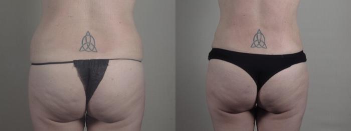Mommy Makeover Case 1240 Before & After Back | Paramus, New Jersey | Parker Center for Plastic Surgery