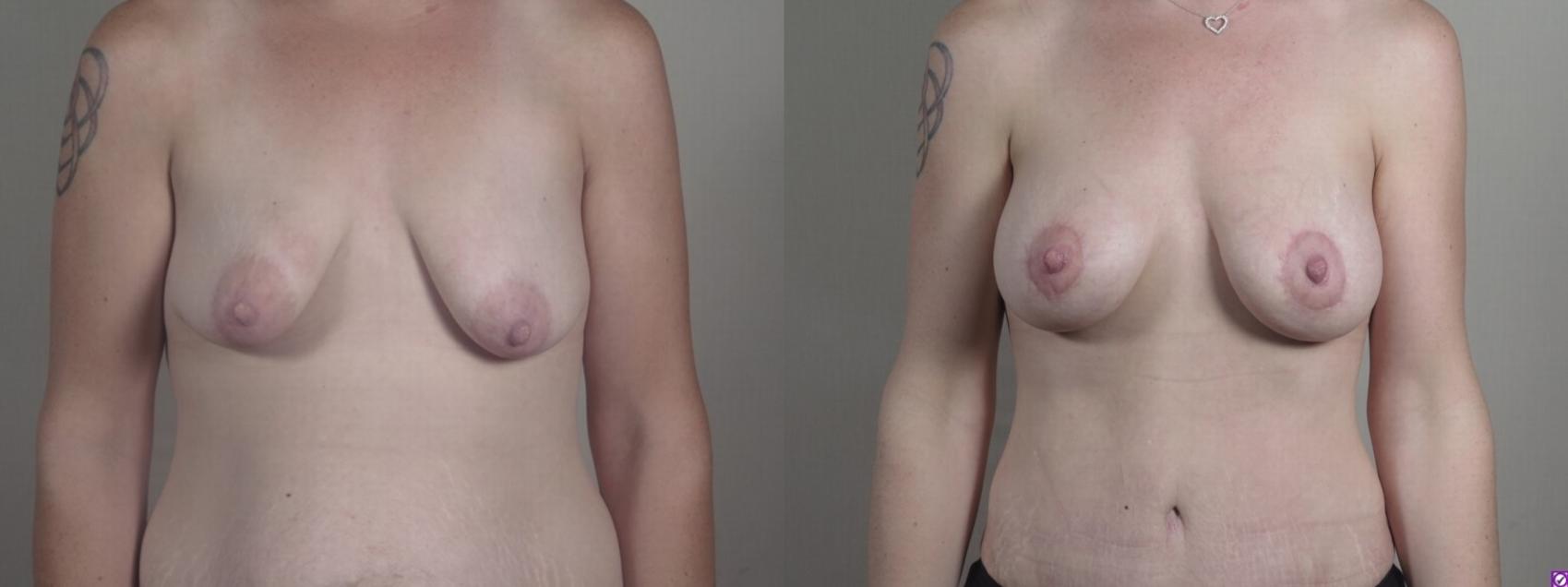 Mommy Makeover Case 1240 Before & After Front | Paramus, New Jersey | Parker Center for Plastic Surgery