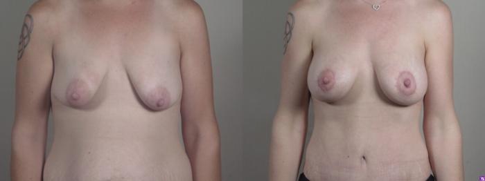 Breast Lift with Auto Aug Case 1240 Before & After Front | Paramus, New Jersey | Parker Center for Plastic Surgery