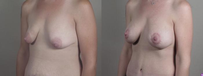 Mommy Makeover Case 1240 Before & After Left Oblique | Paramus, New Jersey | Parker Center for Plastic Surgery