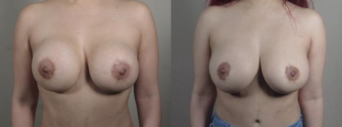 Mommy Makeover Case 1241 Before & After Front | Paramus, New Jersey | Parker Center for Plastic Surgery