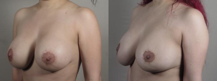 Breast Implant Revision Case 1241 Before & After Left Oblique | Paramus, New Jersey | Parker Center for Plastic Surgery