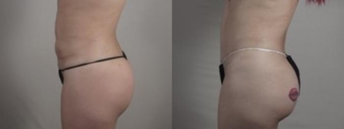 Breast Implant Revision Case 1241 Before & After Left Side | Paramus, New Jersey | Parker Center for Plastic Surgery