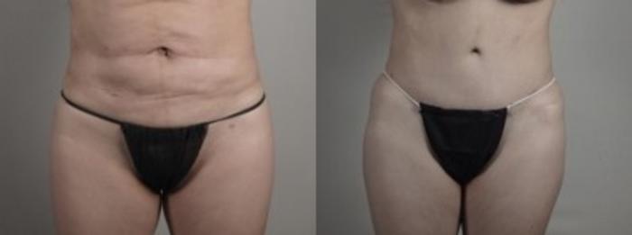 Breast Implant Revision Case 1241 Before & After Lower Front  | Paramus, New Jersey | Parker Center for Plastic Surgery