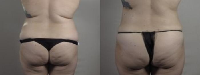 Breast Lift Case 1242 Before & After Back | Paramus, New Jersey | Parker Center for Plastic Surgery