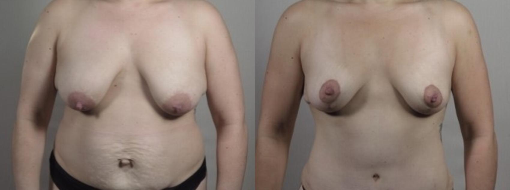 Mommy Makeover Case 1242 Before & After Front | Paramus, New Jersey | Parker Center for Plastic Surgery