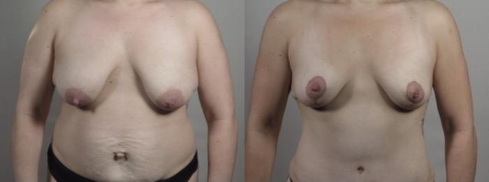 Breast Lift Case 1242 Before & After Front | Paramus, New Jersey | Parker Center for Plastic Surgery