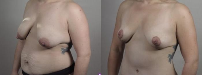 Breast Lift Case 1242 Before & After Left Oblique | Paramus, New Jersey | Parker Center for Plastic Surgery
