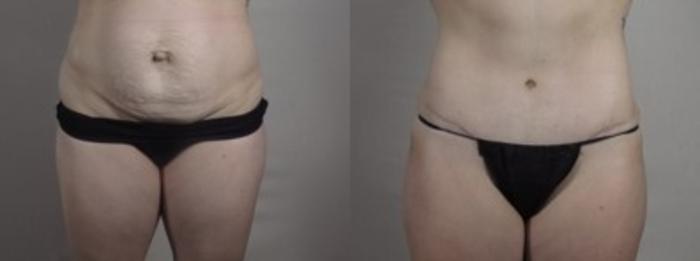 Breast Lift Case 1242 Before & After Lower Front  | Paramus, New Jersey | Parker Center for Plastic Surgery