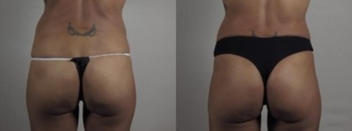 Mommy Makeover Case 1243 Before & After Back | Paramus, New Jersey | Parker Center for Plastic Surgery